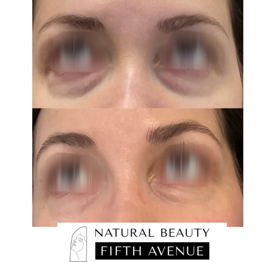 Before and after under-eye treatment with EZ Gel PRF showing reduced puffiness and improved skin texture